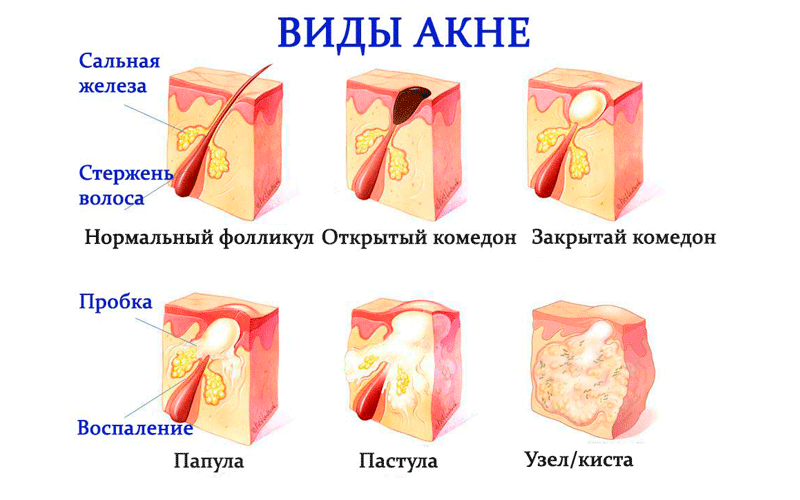 Что поможет против комедонов?